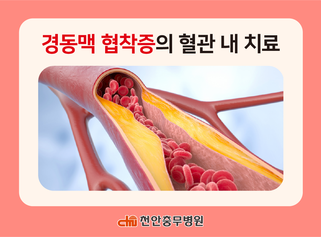 [전문의 칼럼] 경동맥 협착증의 혈관 내 치료